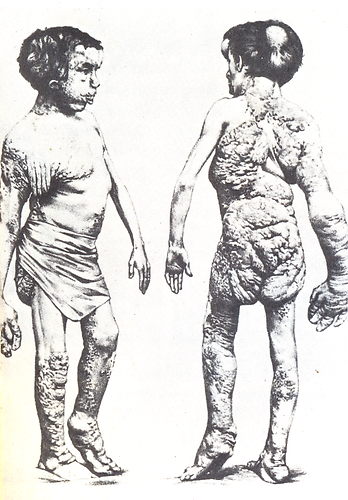 Elephantiasis virus